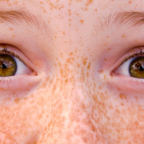 Details about freckles: Right here’s a skin-deep explainer
