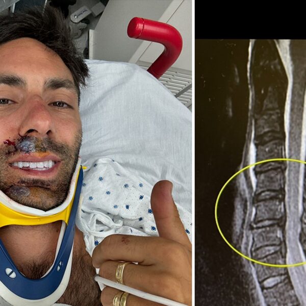 Nev Schulman Breaks Neck in Bike Accident