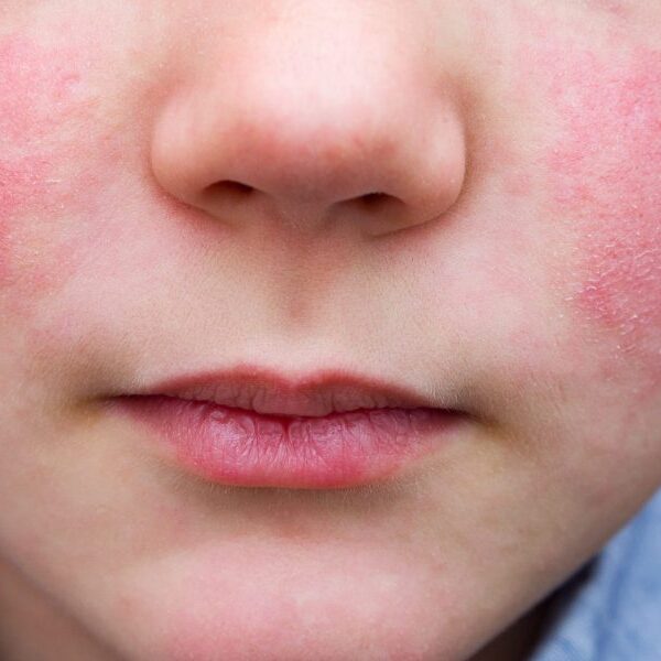 ‘Slapped cheek’ rash: Parvovirus B19 unfold, signs, therapy for adults, youngsters