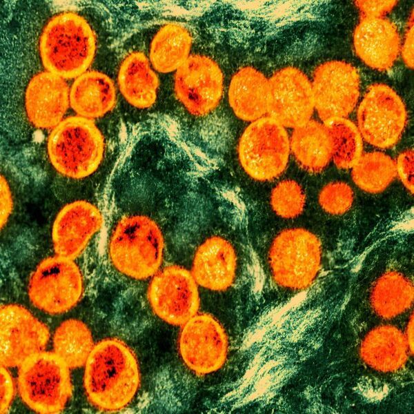 Sweden has its first case of infectious mpox recognized in Congo