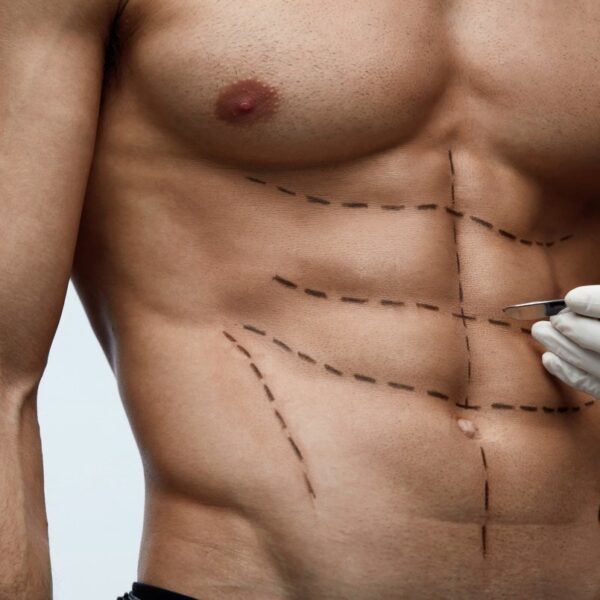 ‘Six-pack surgical procedure’ gaining recognition amongst males, say plastic surgeons