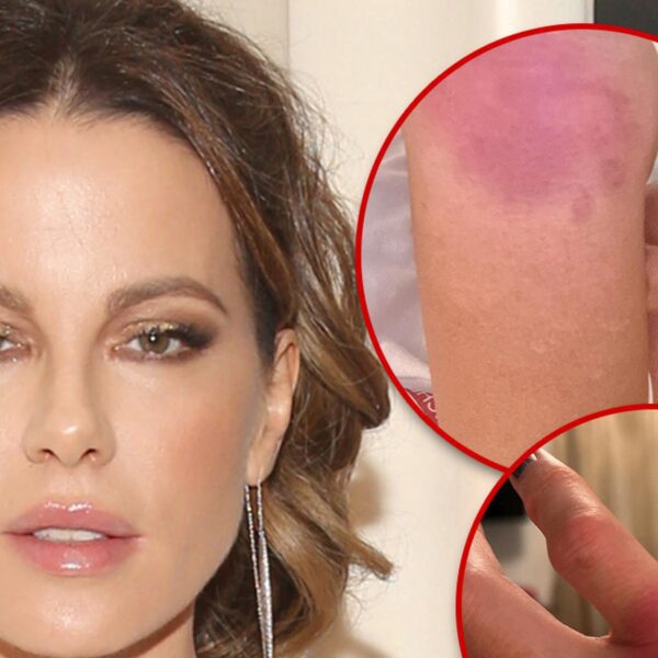 Kate Beckinsale Implies She’s Doing Own Stunts, Posts Gruesome Injury Pics