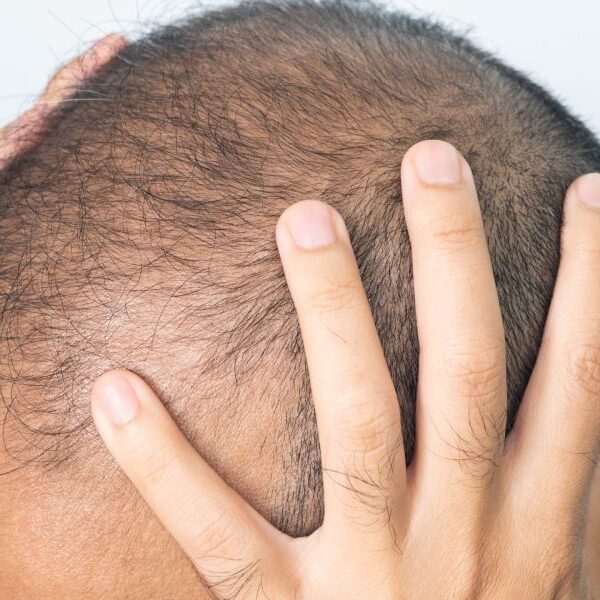 Hair loss drug probed in Europe over hyperlink to suicidal ideas