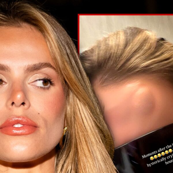 Brooks Nader Shows Off Big Bump on Her Forehead After Walking Into…