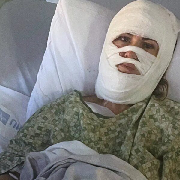 Chemical assault leaves Georgia lady hospitalized with third-degree burns