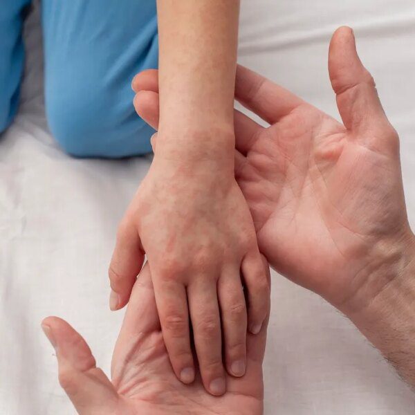 Measles outbreak forces 254 folks into quarantine in South Carolina county