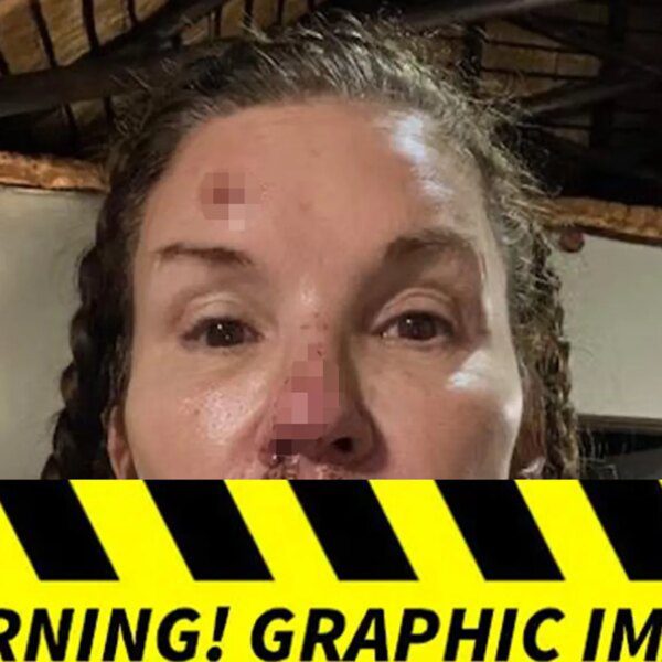 Janice Dickinson’s Photos of Alleged Injuries From Nasty Fall on ‘I’m A&hellip;