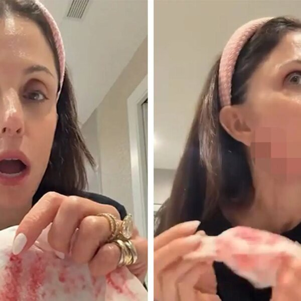Bethenny Frankel Bleeds After Cutting Her Face With Skin Product on Video