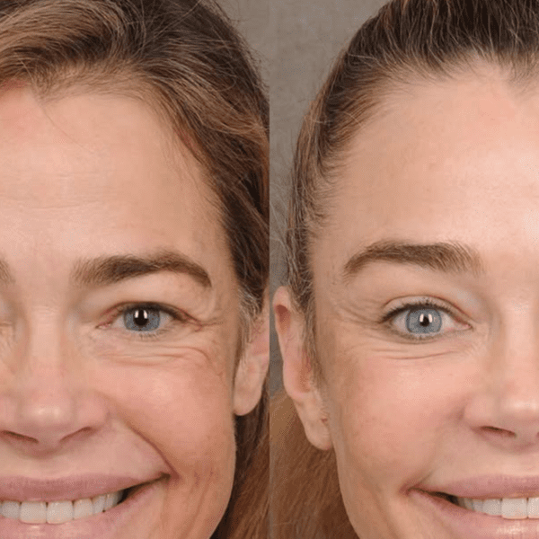 Denise Richards’ Doctor Shares Photos Before and After Facelift