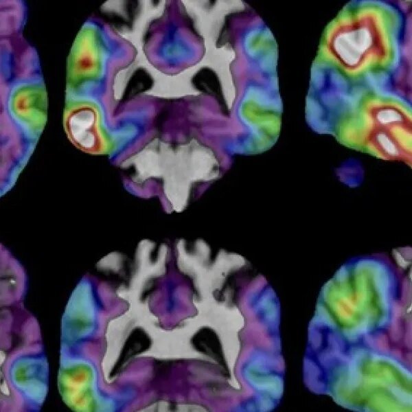 New experimental Alzheimer’s drug exhibits potential after examine exhibits slower cognitive decline