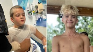 Viral NeeDoh microwave development leaves teen with third-degree burns