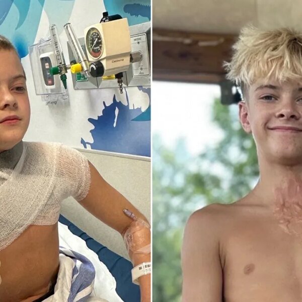 Viral NeeDoh microwave development leaves teen with third-degree burns