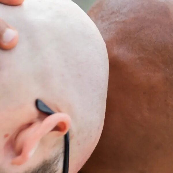 Forget GLP-1 shares, baldness medication are Wall Street’s subsequent goldmine