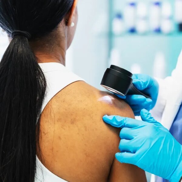 Cancer vaccine stops melanoma from returning or spreading in historic trial
